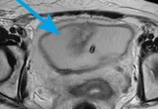 BLADDER PERFORATION