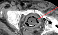 BLADDER PERFORATION