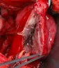 BLADDER RUPTURE