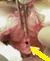 BLADDER PERFORATION