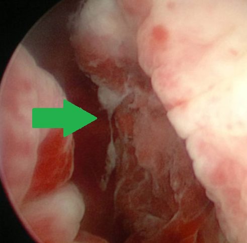 BLADDER PERFORATION