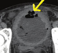 BLADDER PERFORATION