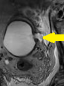 BLADDER PERFORATION