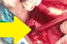 BLADDER PERFORATION