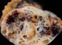 CAVERNOUS HEMANGIOMA SPERMATIC CORD