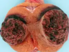 CHORIOCARCINOMA