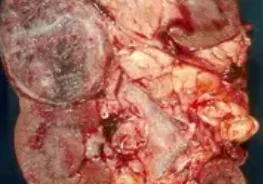 CHROMOPHOBE RENAL CELL CARCINOMA