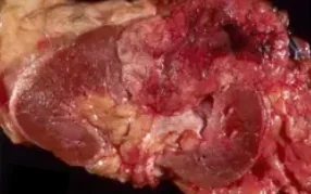 CLEAR RENAL CELL CARCINOMA