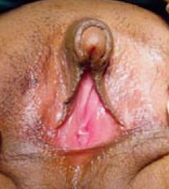 CLITOROMEGALY 