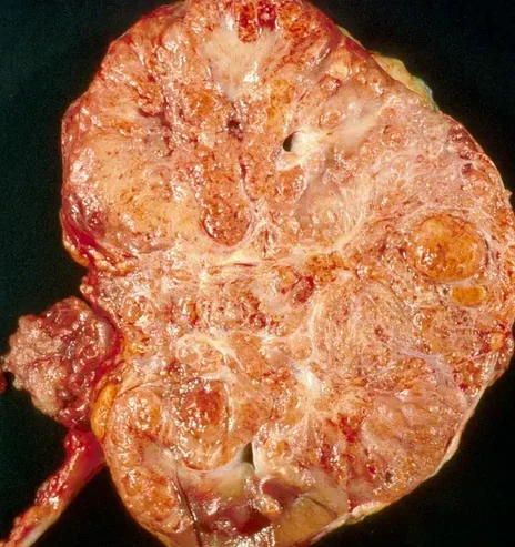 COLLECTING DUCT CARCINOMA
