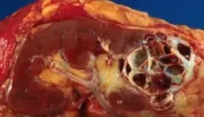 CYSTIC RENAL NEOPLASM