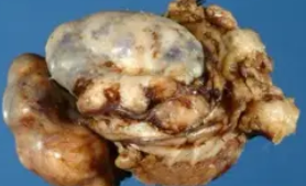 DESMOPLASTIC SMALL ROUND CELL TUMOR1