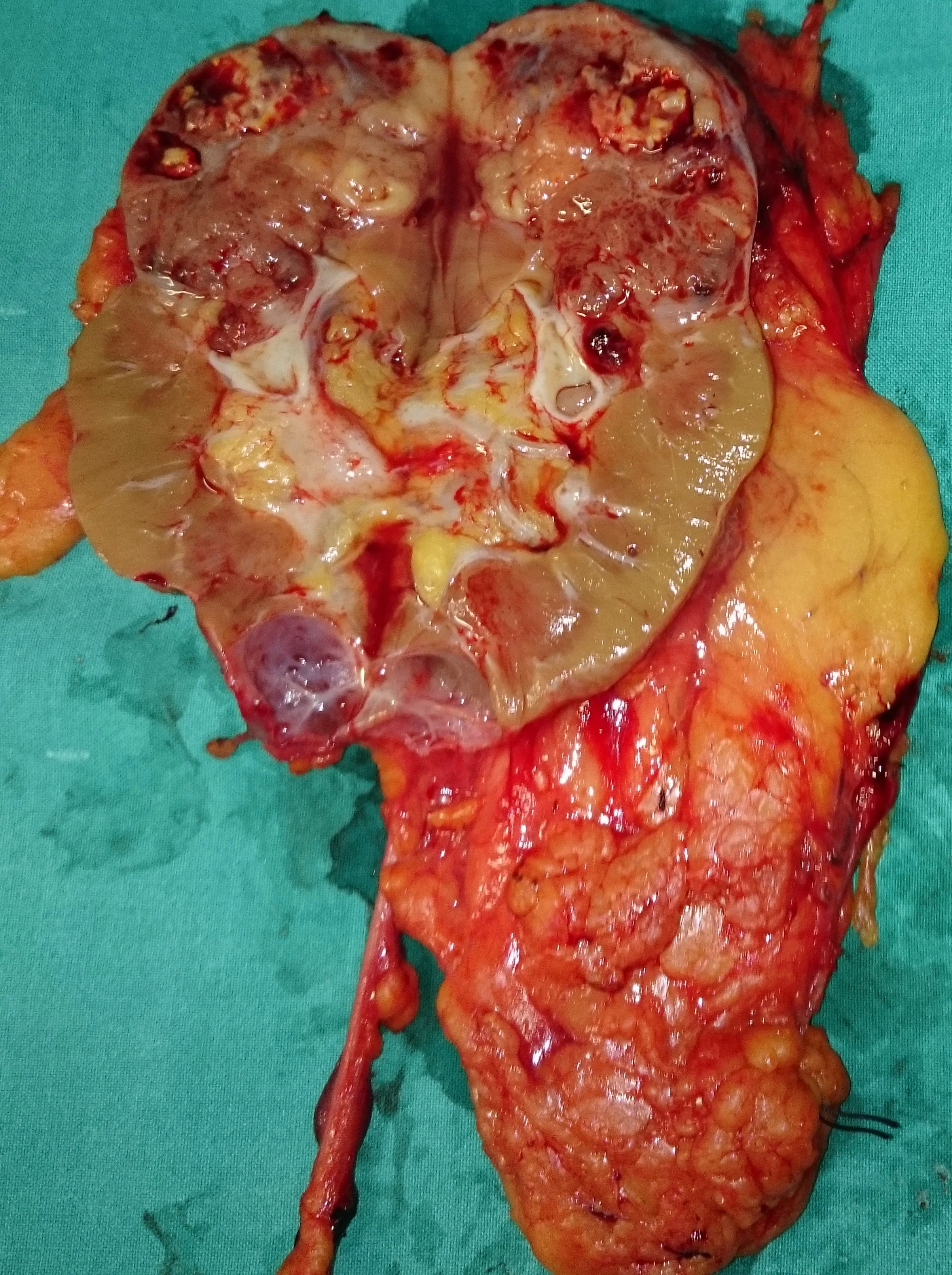 RENAL CARCINOMA