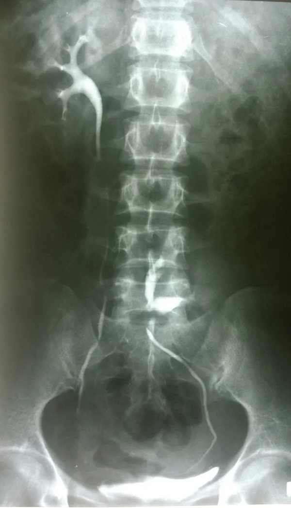 ECTOPIC PELVIC KIDNEY 