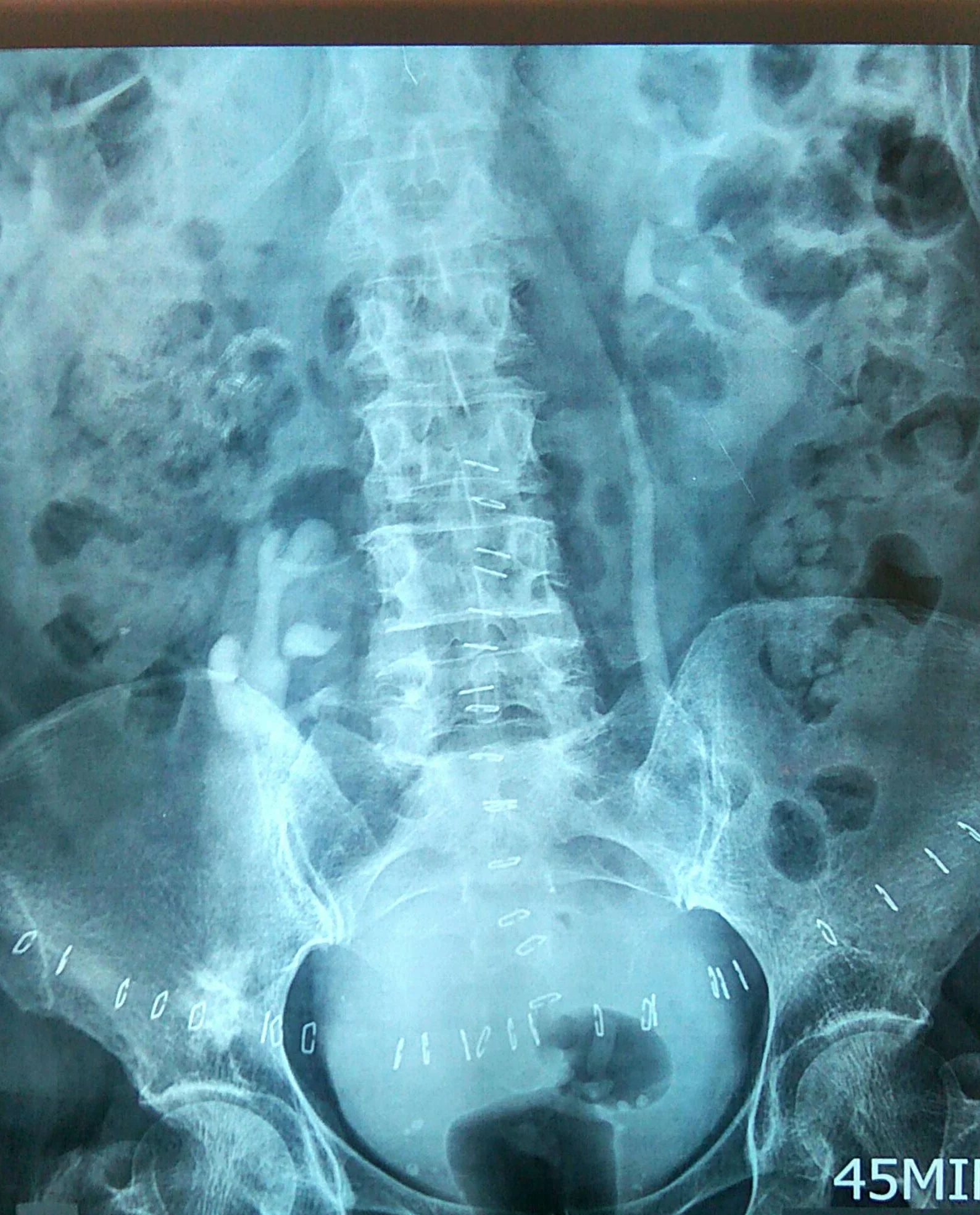 ECTOPIC PELVIC KIDNEY 