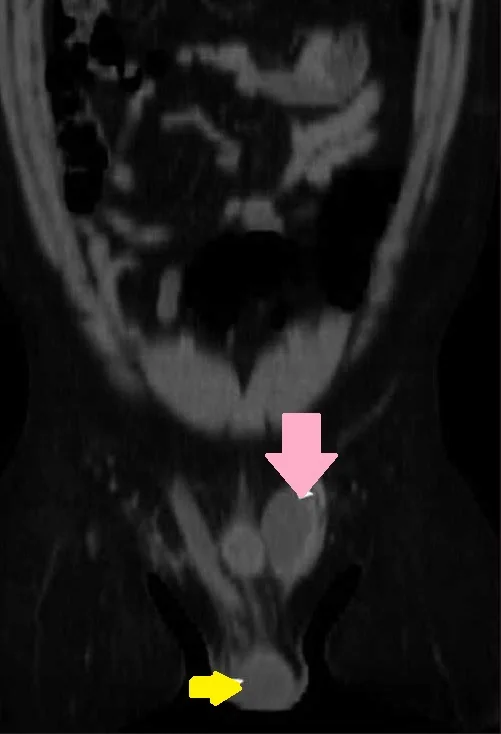 ECTOPIC TESTIS 