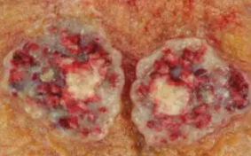 EMBRYONAL CARCINOMA