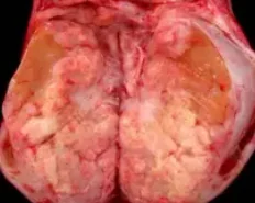 EMBRYONAL CARCINOMA 