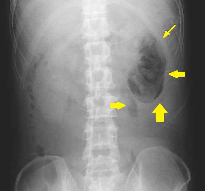 EMPHYSEMATOUS  PYELONEPHRITIS