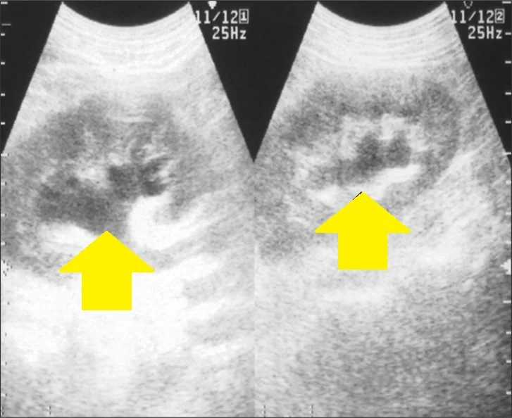 ENLARGED RENAL PELVIS - RETROPERITONEAL FIBROSIS 