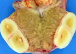 FIBROUS PSEUDOTUMOR
