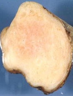 FIBROUS TESTICULAR PSEUDOTUMOR