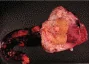 GONADAL STROMAL TUMOR