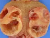 GRANULOSA CELL TUMOR