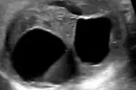SCROTAL ECHO - GRANULOSA CELL TUMOR 