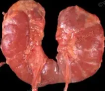 HORSESHOE KIDNEY