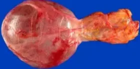HYDROCELE