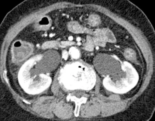 HYDRONEPHROSIS