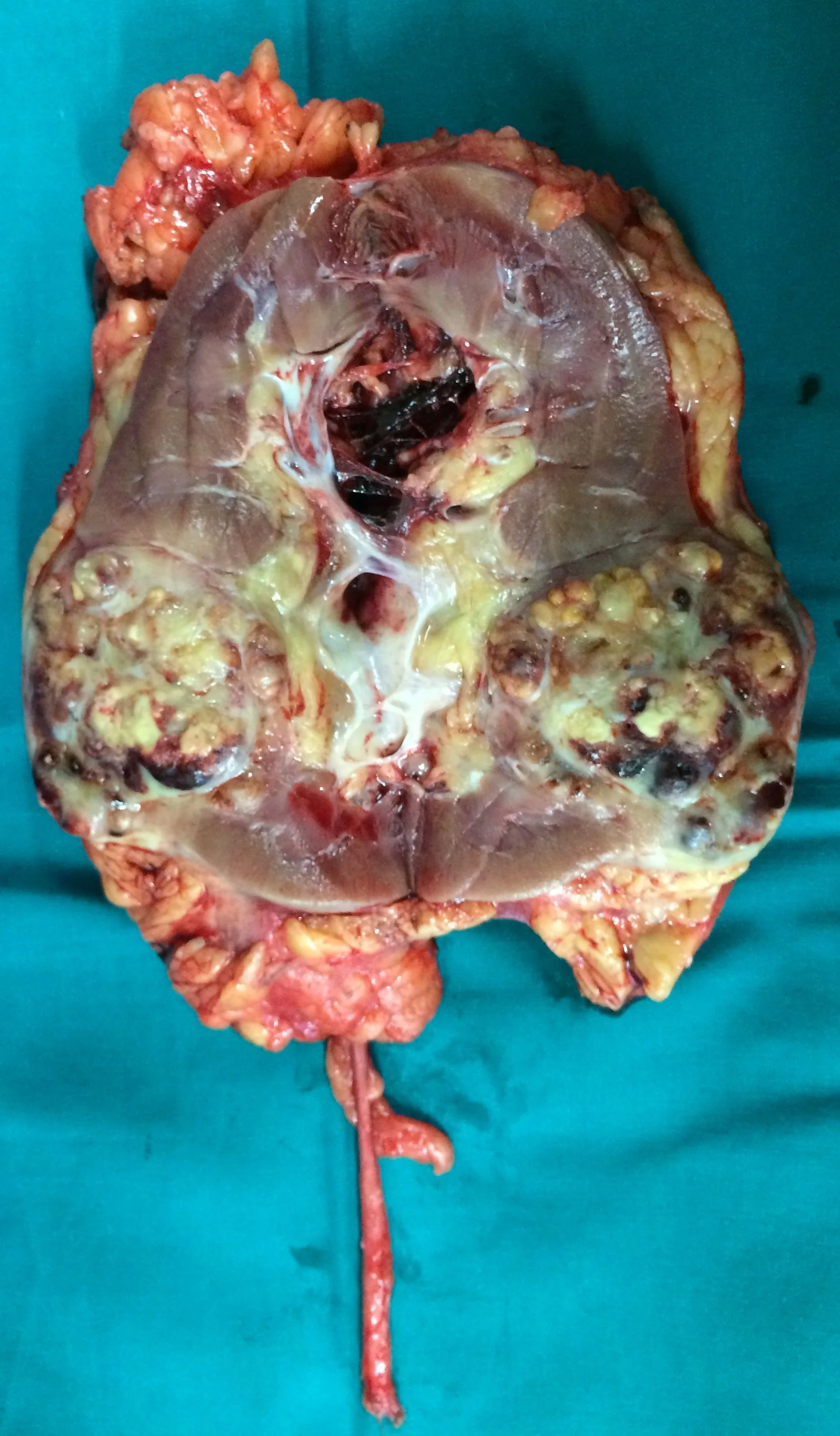 RENAL CARCINOMA
