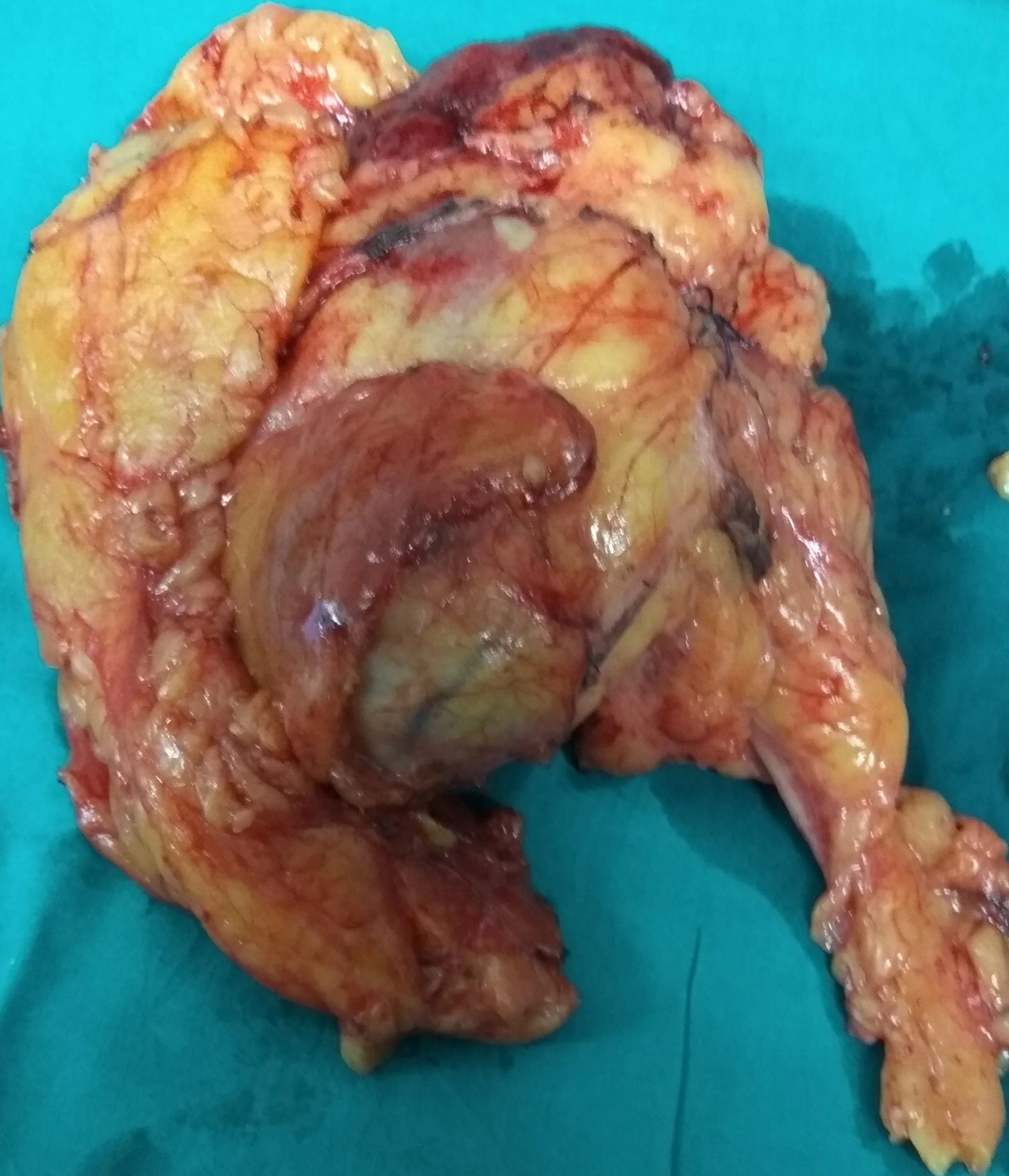 RENAL CARCINOMA