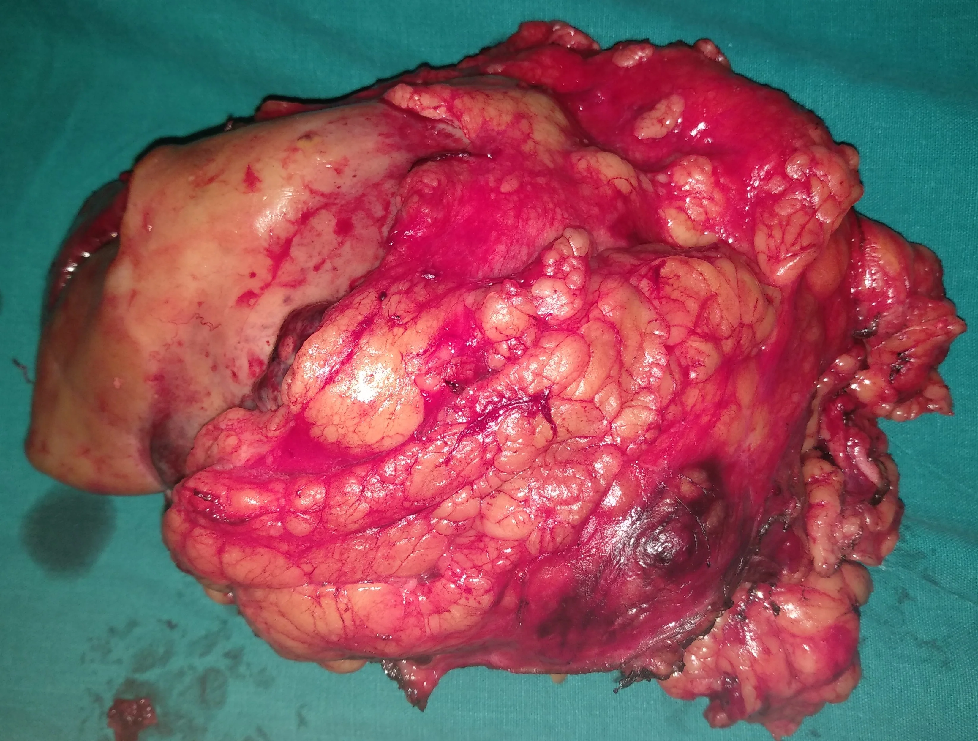 RENAL CARCINOMA