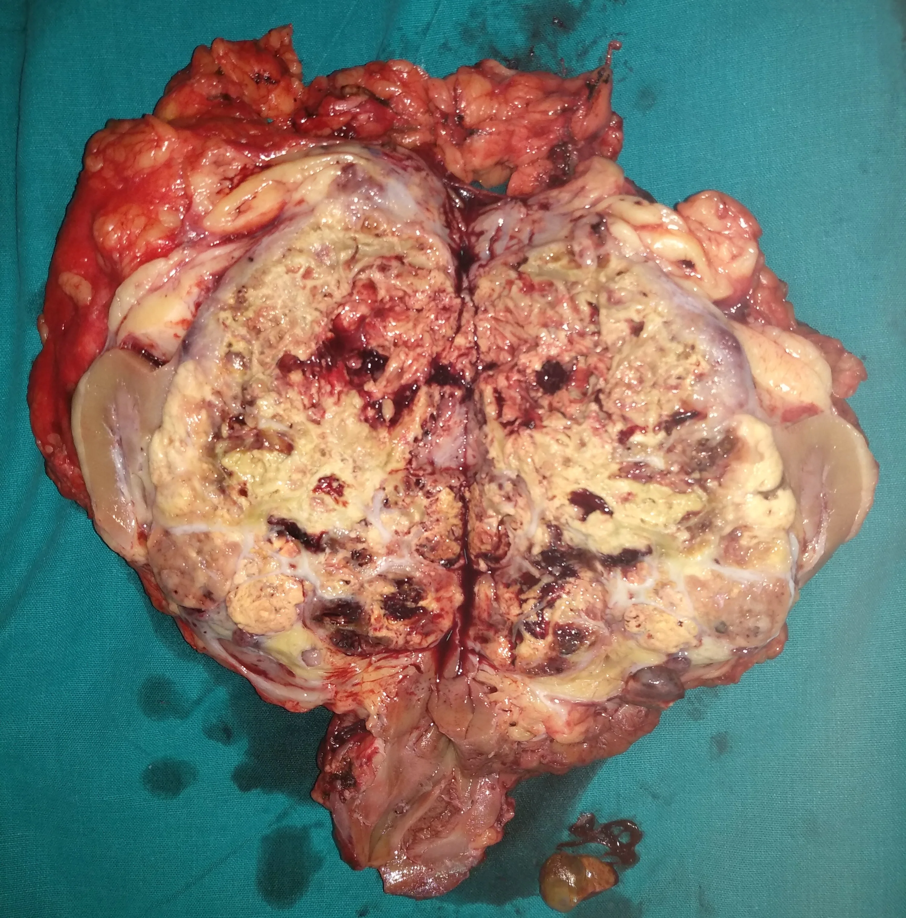 RENAL CARCINOMA