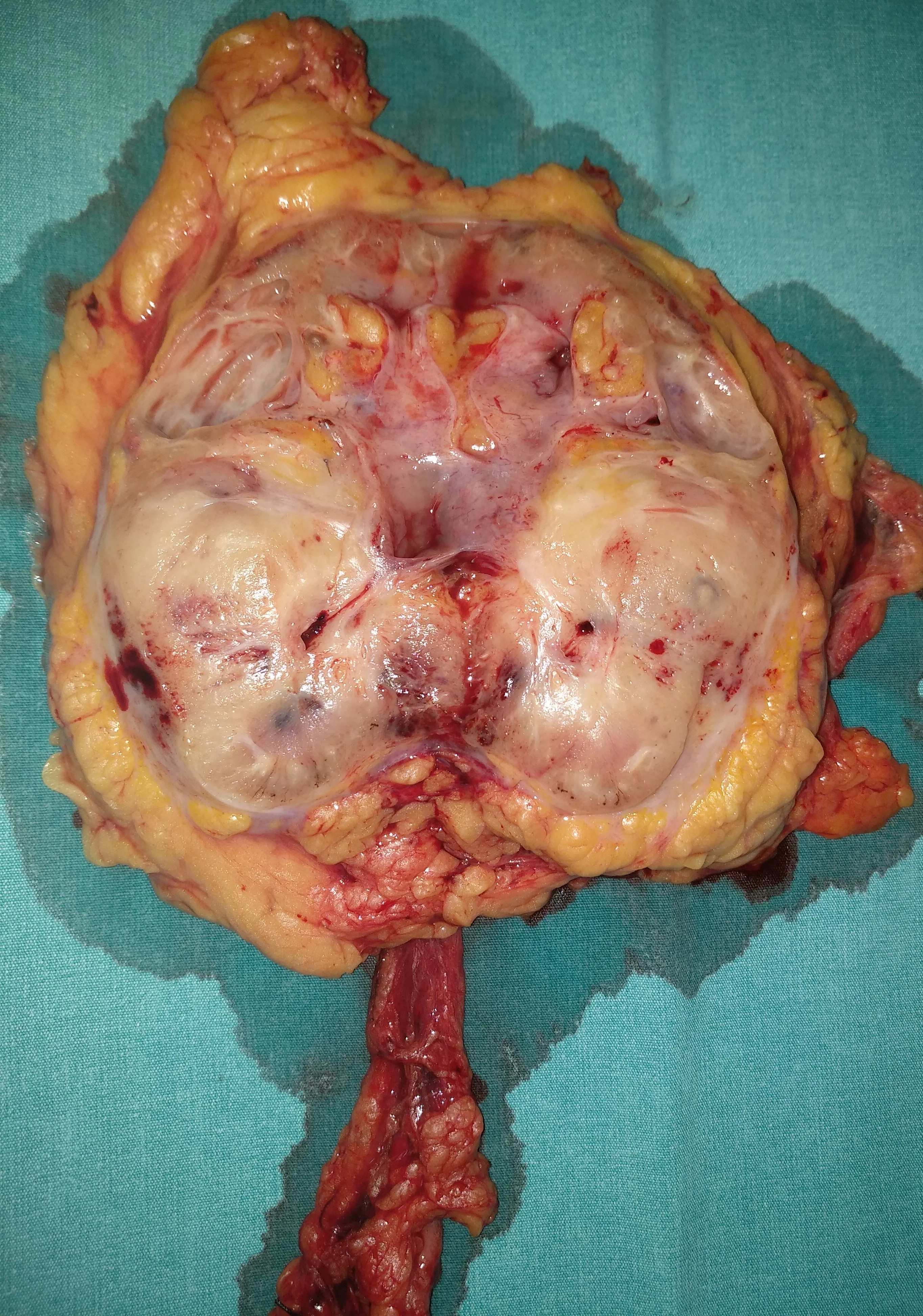 RENAL CARCINOMA
