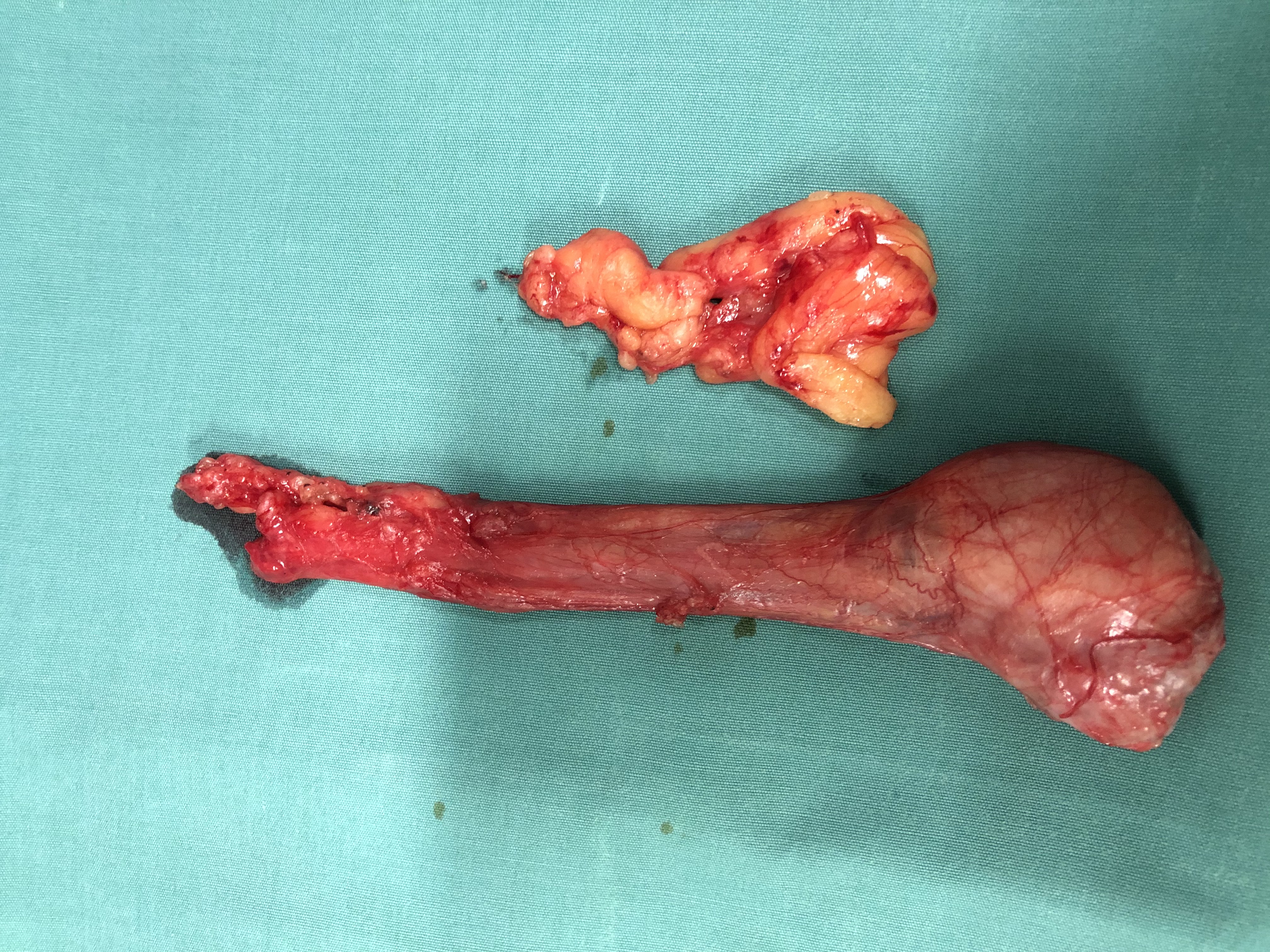 ORCHIDECTOMY SPECIMEN