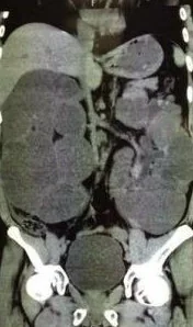 ENORMOUS KIDNEY SIZE