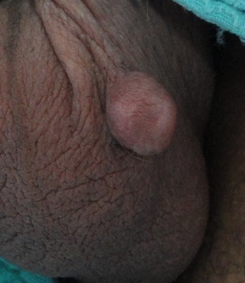 LEIOMYOMA SCROTUM