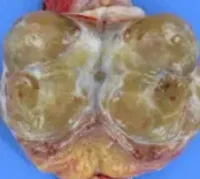LEYDIG CELL TUMOR