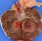 LEYDIG CELL TUMOR 