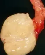 LIPOMA SPERMATIC CORD