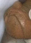 MEDIAN RAPHE CYST PENIS
