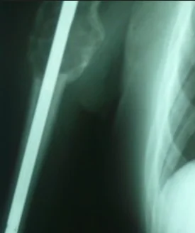 RENAL CARCINOMA - HUMERAL METASTASIS