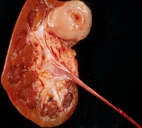 METANEPHRIC ADENOMA