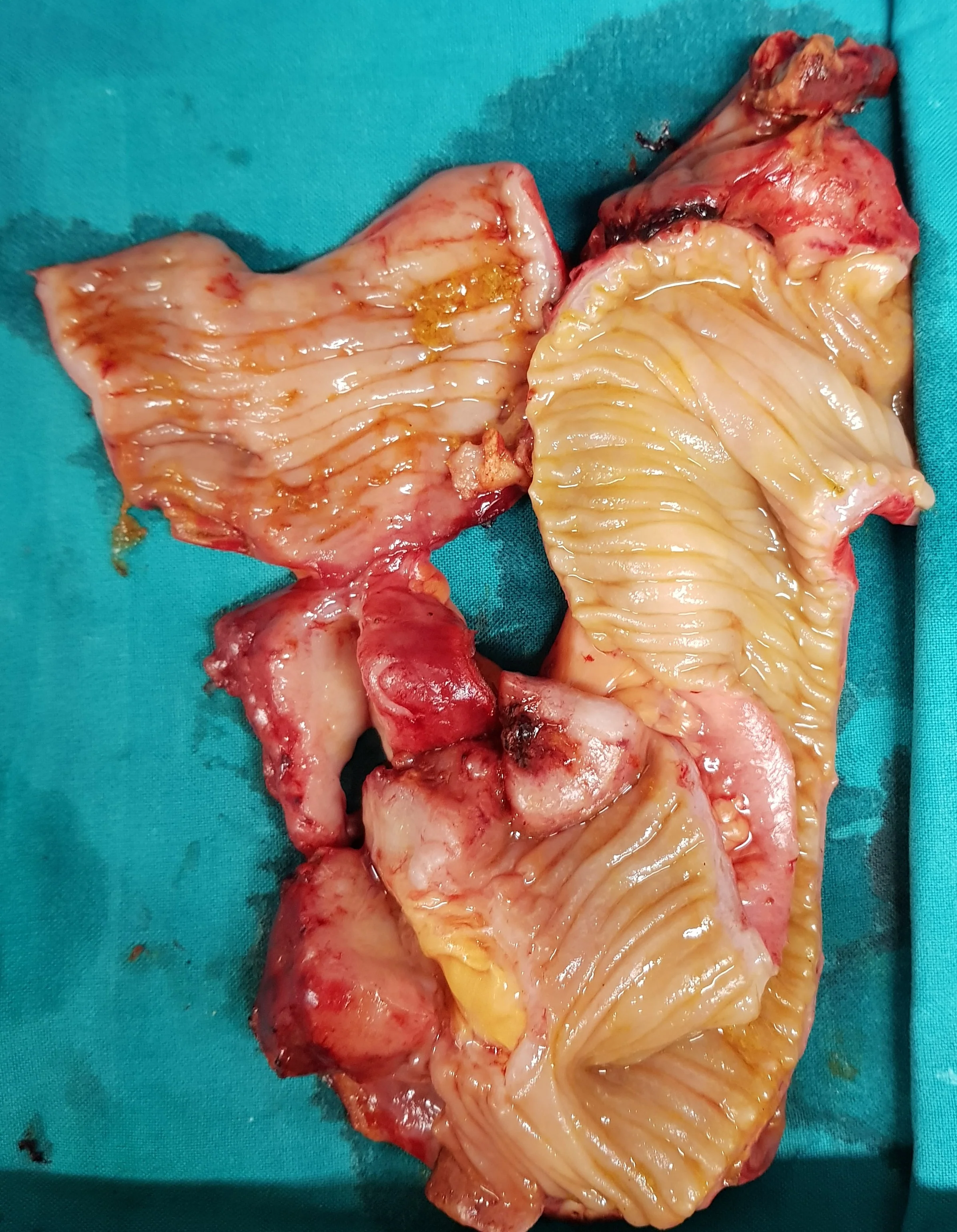 BLADDER CARCINOMA - INTESTINAL METASTASES