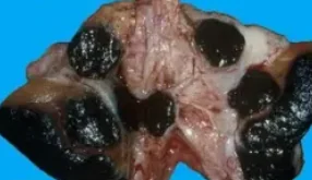 METASTATIC MELANOMA