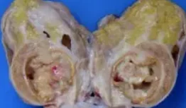 METASTATIC UROTHELIAL BLADDER CARCINOMA1