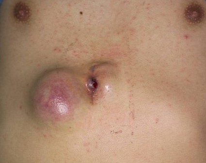 MIXED GERM CELL TUMOR - CUTANEOUS METASTASIS